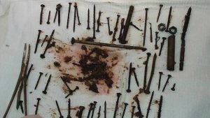 Γυναίκα κατάπιε καρφιά και βίδες – Δεν διανοείστε για ποιον λόγο! (photos)