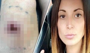 Ξύπνησαν και βρήκαν τρύπες στο σώμα τους από δάγκωμα αράχνης (Σκληρές εικόνες)