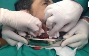 Οι γιατροί έπαθαν σοκ μόλις είδαν τι έπρεπε να βγάλουν από το σαγόνι αυτού του άνδρα (video)