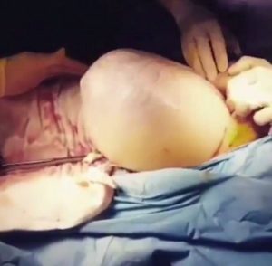 Μωρό γεννήθηκε μέσα στον αμνιακό του σάκο και το θέαμα είναι εντυπωσιακό (video)